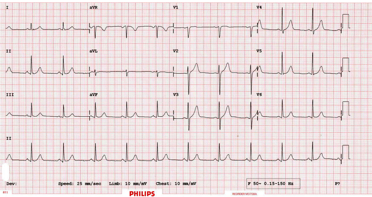 Reading An Ekg Chart