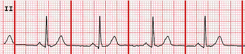 ECG II