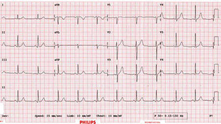 ECG