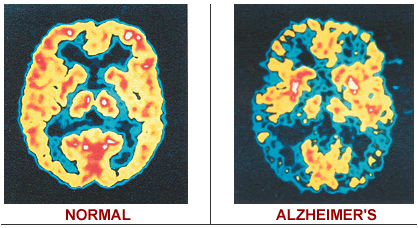 dementia brain scan