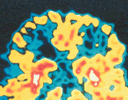 dementia brain scan